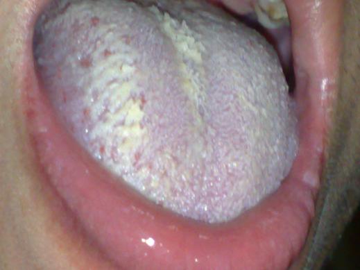 艾滋病初期舌头症状!多种多样